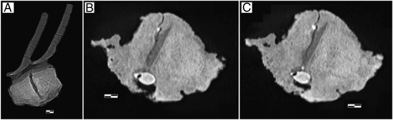 CT scans of the fused hadrosaur vertebrae, showing embedded theropod tooth and reactive bone ( A–C ). Longitudinal slice through the fused vertebrae shows the substantial overgrowth of reactive bone on the outside of the centra, while the articular surfaces remain largely unaffected ( A ). Two oblique slices through the vertebrae show the embedded theropod tooth in cross-section and the reactive bone that partially surrounds it ( B and C ). (Scale bars: A , 20 mm and B and C , 10 mm.)